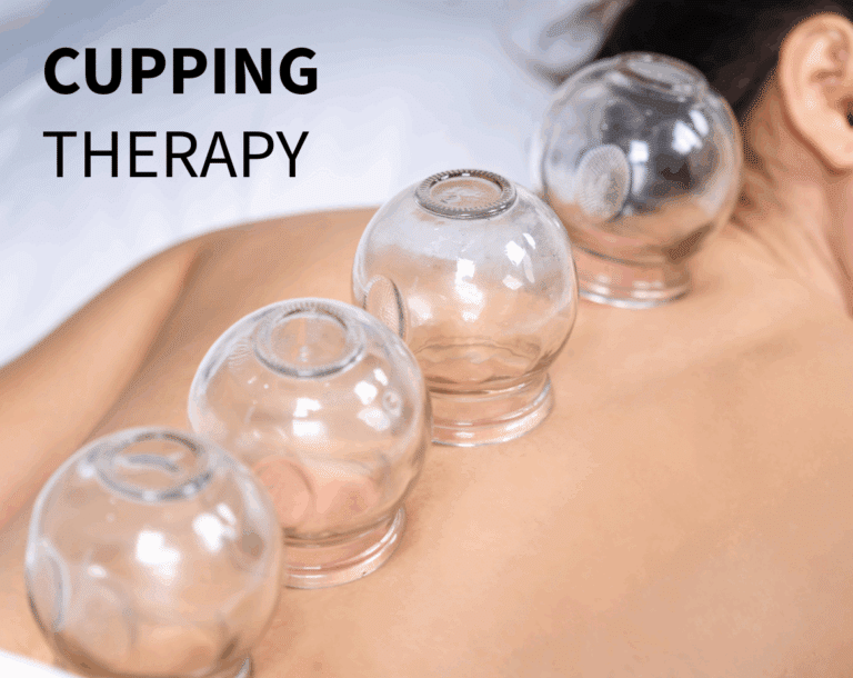 Cupping Therapy by Registered Acupuncturist